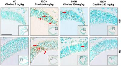 The ameliorative effects of choline on ethanol-induced cell death in the neural tube of susceptible BXD strains of mice